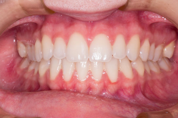 carillas dentales accesibles en guadalajara