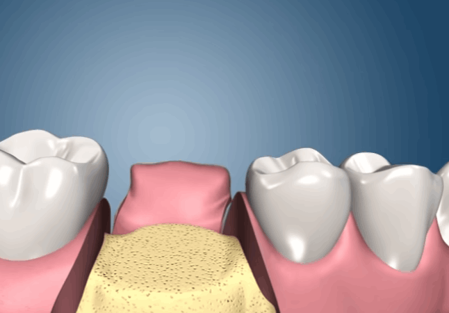 Implantes dentales de titanio en Guadalajara