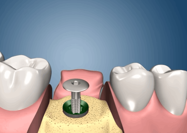 tornillos para implantes dentales en guadalajara